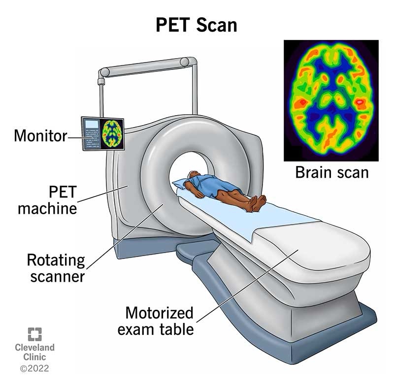 PET Scan 2025 #11 – Hodgkin’s Lymphoma Awareness Ireland